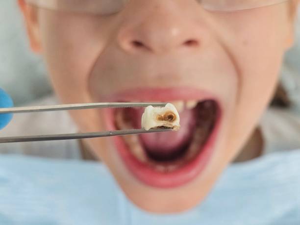 Best Emergency Wisdom Teeth Removal in New Lenox, IL